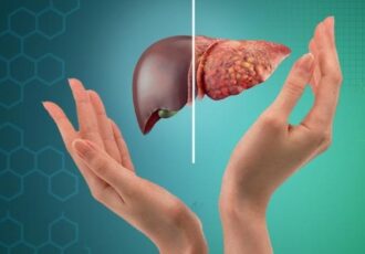 کبد چرب؛ بیماری خاموش جوامع امروزی کبد چرب؛ بیماری خاموش جوامع امروزی