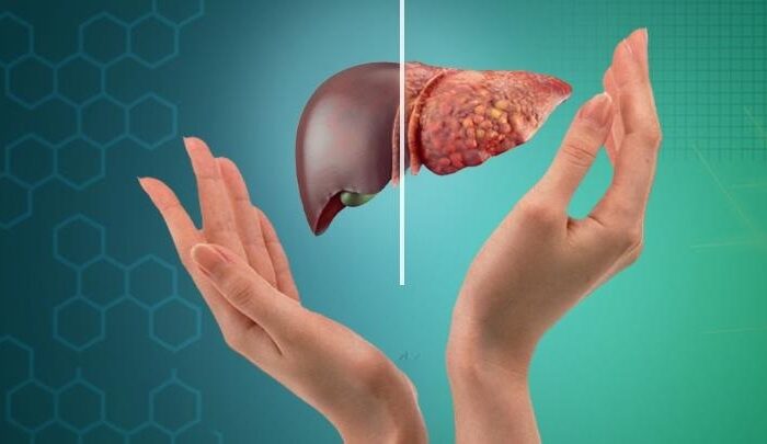کبد چرب؛ بیماری خاموش جوامع امروزی